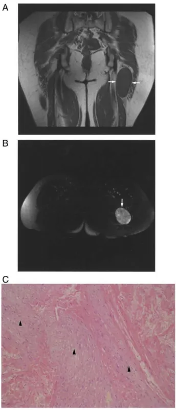 Fig. 4. Images of a neurilemoma involving the sciatic nerve in the left gluteal region in a 55-year-old woman
