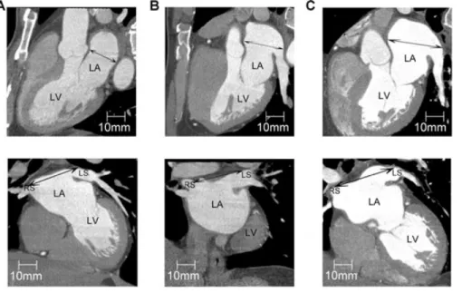 Figure 2. Oblique sagittal view (upper panels) and oblique coronal (lower  pan-els) view during the multidetector  com-puted tomography in the patients in the control (panel A), medium calcium score (panel B), and high calcium score (panel C) groups
