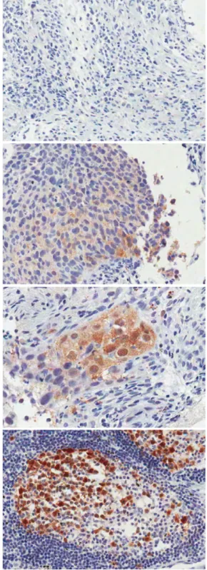 Fig. 1. Immunohistochemical staining for TS in tumor tissues.