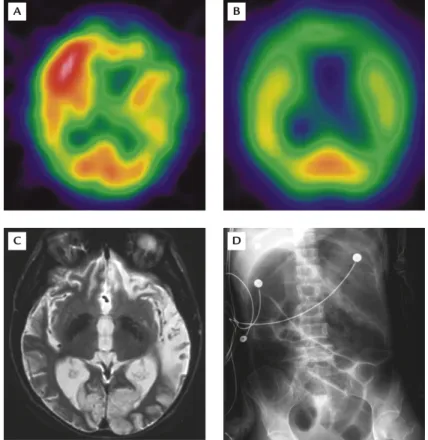 Figure 2. Brain single photon emission computed  tomography of the proband in the MELAS family:  (A) decreased radioactivity in the left occipital area and