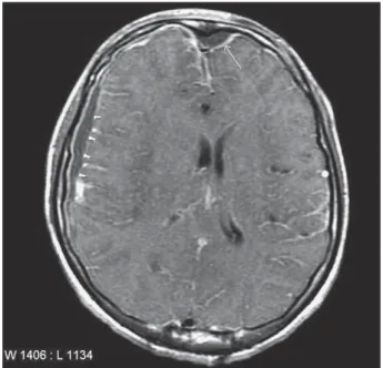 Figure 2. On craniotomy, purulent ﬂuid was found in the subdural and subarachnoid spaces.