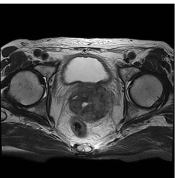 Fig. 1 Magnetic resonance imaging showing an enlarged prostate with symmetrical expansion and compression of the rectum and urinary bladder