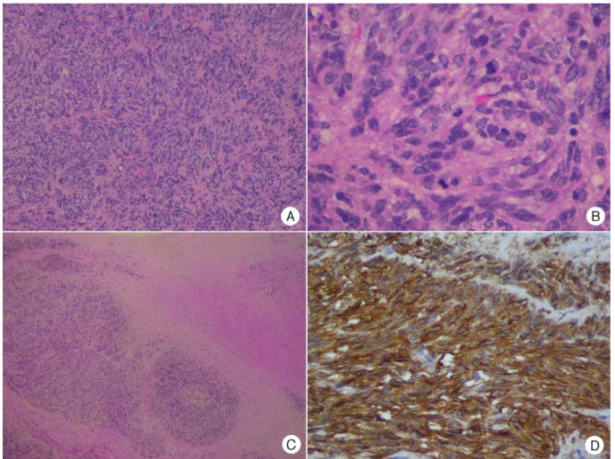 Fig. 2 The prostate having almost totally been replaced by a cellular tumor composed of spindle and a few epithelioid cells with a vague arrangement in short fascicles (A), moderate cytological pleomorphism with a high mitotic rate (B), large areas of necr