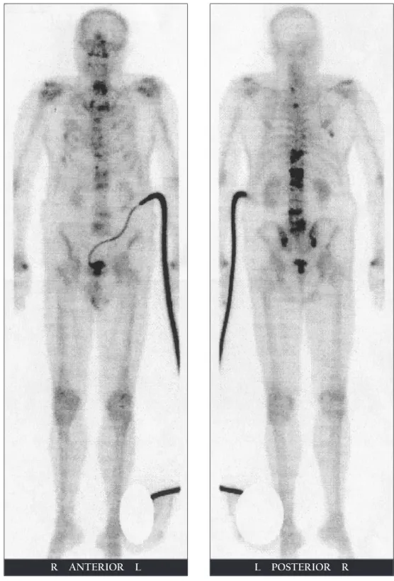 Fig. 2 (A) Bone scan showing skeletal metastases in the ribs, T1-L5 spine, sacrum,