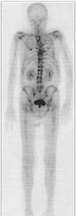 Fig. 2 (B) Follow-up bone scan revealing partial resolution of the previous metastatic lesions in the T11, T12, L1, L2, L4, and L5.