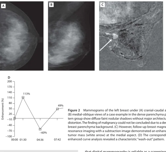 Figure 2  Mammograms of the left breast under (A) cranial-caudal and 