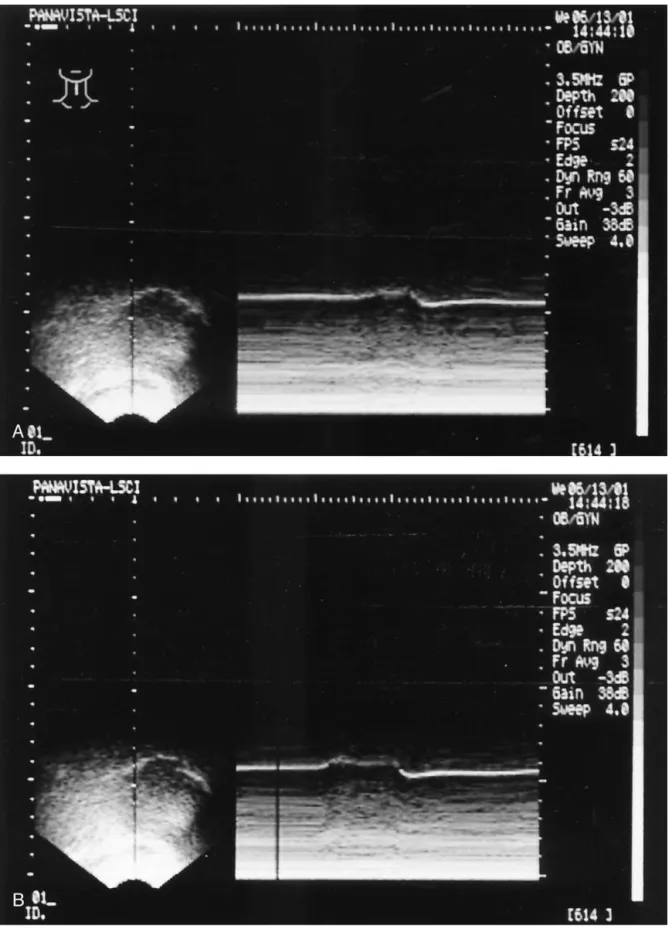 Fig 4. A-E, Five B- ⫹ M-mode ultrasonogram of one participant during production of /e/ (A), /i/ (B), /aI/ (C), /o/ (D), and