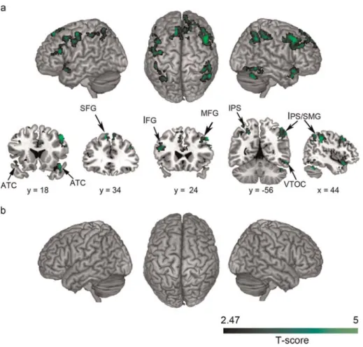 Figure 2. Brain regions that showed significant MRS between addition and subtraction problems