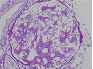 Figure 1 Paramesangial deposits in a glomerulus of an IgA nephropathy patient viewed by light microscopy (periodic acideSchiff staining).