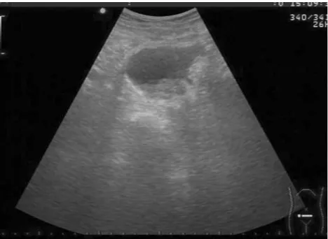 Fig. 1. Prostate sonography showed lobulated prostate mass with intra-vesical protruding.