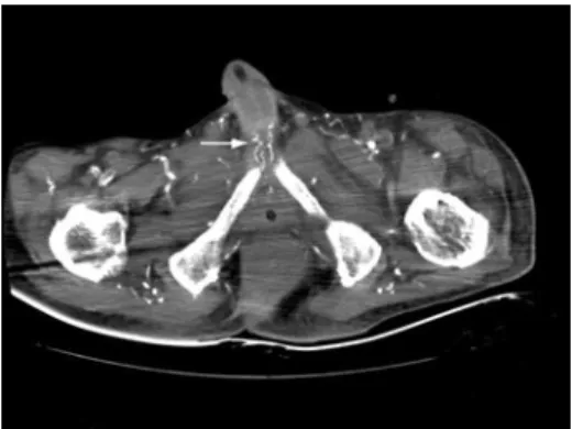 Fig. 2. Non-contrast CT scan showing bilateral penile artery calciﬁcation (arrow).