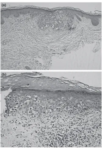 Figure 1. (a) Enlargement of right areola. (b) Close-up view of the right side areola shows mottled hyperpigmentation with minimal scaling.