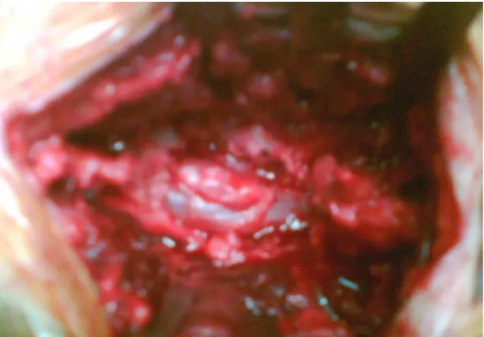 Fig. 2. Preoperative view of the dural sac after L5 laminectomy showed extracted disk fragment with yellowish appearance and attachment to the posterior dural sac.