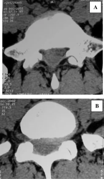 Fig. 3. Lumbar CT scan in the second case showed left lateral herniated disk at L5-S1 (A) and posteriorly located mass, which appears isodense to the intervertebral disk (B).