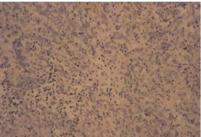 Fig. 2 Immunohistochemistry study negative for  prostatic-specific antigen (400X). 