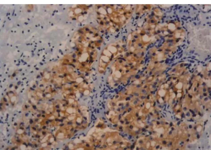 Fig. 3 Poorly differentiated adenocarcinoma of the  prostate positively reactive to prostatic-  spe-cific antigen (400X)