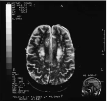 Figure 2. T 2 -weighted imaging (TR/TI/excitation = 2400/0/ 100) from a subject with delusional disorder due to diffuse cerebrovascular disease (Case 4) shows that brain atrophy with multiple lucunar infarcts in the periventricular white matter.