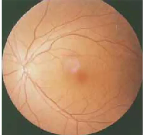 Figure 6 The pattern of retinal blood vessels  (Artery and Vein) 