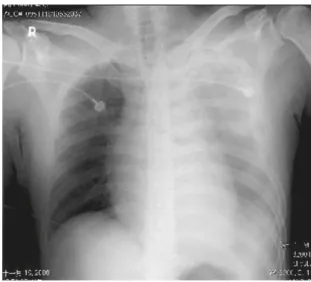 Figure 1  Massive hemothorax on the left side. There is no 