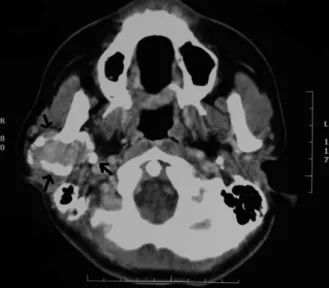 Fig. 2. Panoramic radiograph reveals a well-circumscribed, mixed radiolucent-radiopaque mass on the posterior border of the mandible, measuring about 3 ⫻ 4 cm (arrows).