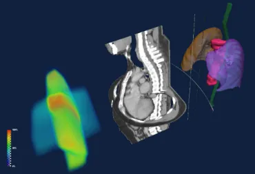 Figure  1:   The  volumetric  visualization  of  a  typical  radiotherapy  treat- treat-ment  plan  consists  of  three  volumetric  datasets  including,  from  left  to right:  RT  dose,  CT  images  and  RT  structure  models.
