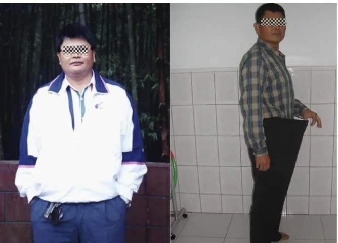 Fig.  1:  A  45-year-old  man  before  (105.1  kg)  and  6  months  after  (81.0  kg)  laser  acupuncture treatment.
