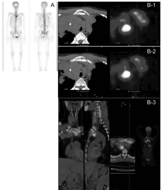 FIGURE 2. A, 99m Tc MDP whole-body bone scan: Regionally increased activity in left sternal manubrium corner is only seen