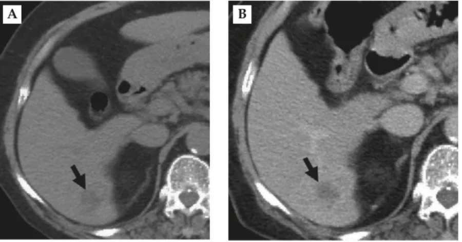 Figure 2. Abdominal computed tomography shows hepatocellular carcinoma with liver abscess
