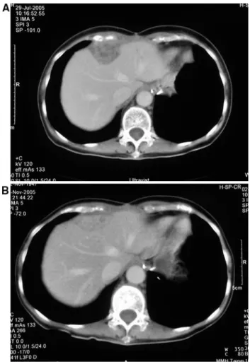 Fig. 1 Computed tomography of the abdomen of case 3. (a) Before discontinuation of imatinib showing a new hepatic metastatic tumor at the anterior aspect of hepatic dome (4.4 · 3.1 cm)