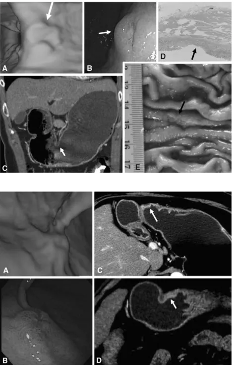Fig. 1. EGC type IIc in a 51-year-old woman that was diagnosed by VG. A VG image shows a superficial depressed lesion (arrow) at the gastric angle