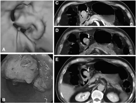 Fig. 3. Advanced T2 gastric cancer