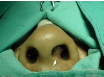 Fig. 1 Mass in the nasal septum (arrow)