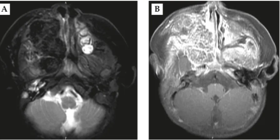 Figure 2. (A) Axial T2-weighted image demonstrating an extremely hypointense expansile mass in the right maxillary sinus