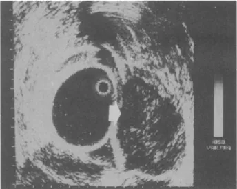 Figure  2.  Patient  2.  Endorectal  ultrasound  image  show-  ing  a hypoechoic  well-delineated tumor that  involves  the  muscularis  propria (arrow)