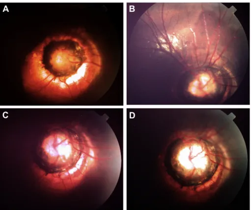 Figure 1. (A) Ophthalmoscopic images of contracted stage showing disc appearance resembling that of morning glory disc anomaly; (B, C, and D) image series of disc in expanded stage showing funnel-shaped peripapillary staphyloma.