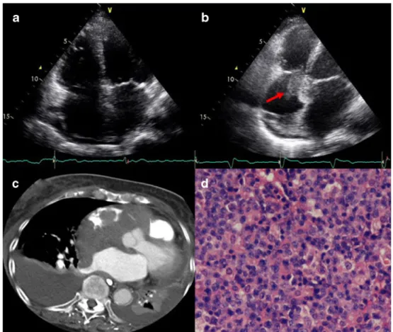 Fig. 1 a Echocardiography performed before permanent pacemaker implantation showed dilatation of the left atrium