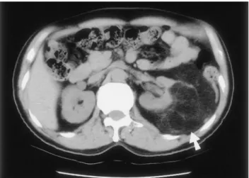 Figure 1.  Computed tomography of a low-density mass, exophytic from left renal cortex (arrow).