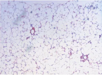Figure 2.  Tumor pathology reveals mature adipose cells in lobular pattern (hematoxylin &amp; eosin,  ×  40).