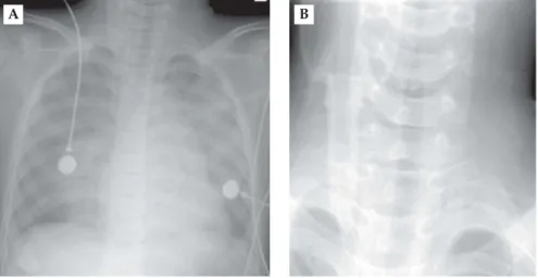 Figure 1. Chest radiographs demonstrating (A) alveolar infiltrates in both upper lung fields and (B) steeple sign in a 5-year-old boy with acute dyspnea.