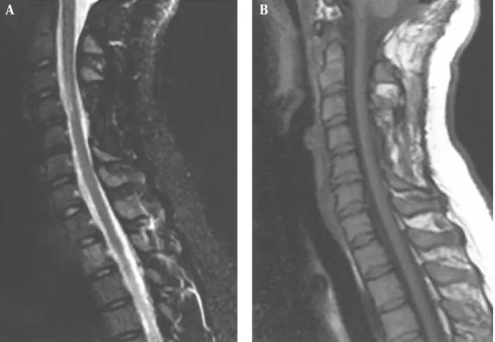Figure 2.  Postoperative unenhanced sagittal magnetic resonance images of the craniocervical junction and cervical spine (12 months after surgery) demonstrate reduction in syrinx size: (A) T2-weighted; (B) T1-weighted.
