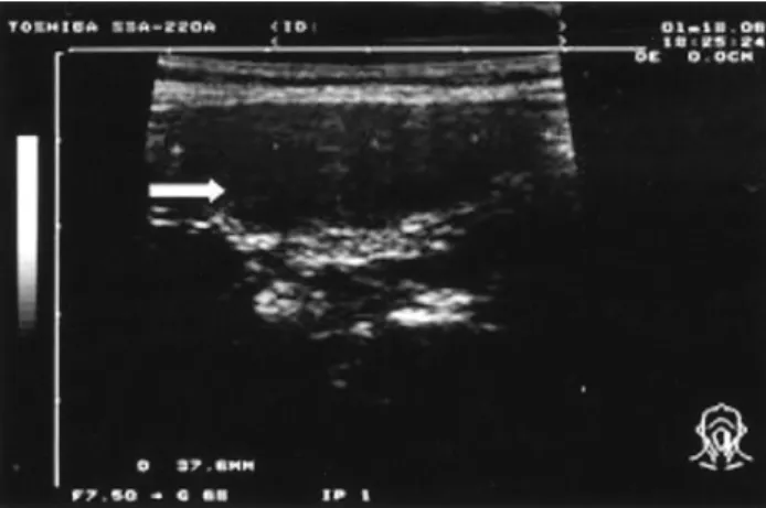 Figure 1.  Thyroid ultrasonography showed a hypoechogenic area over the left lobe of the thyroid gland (arrow).