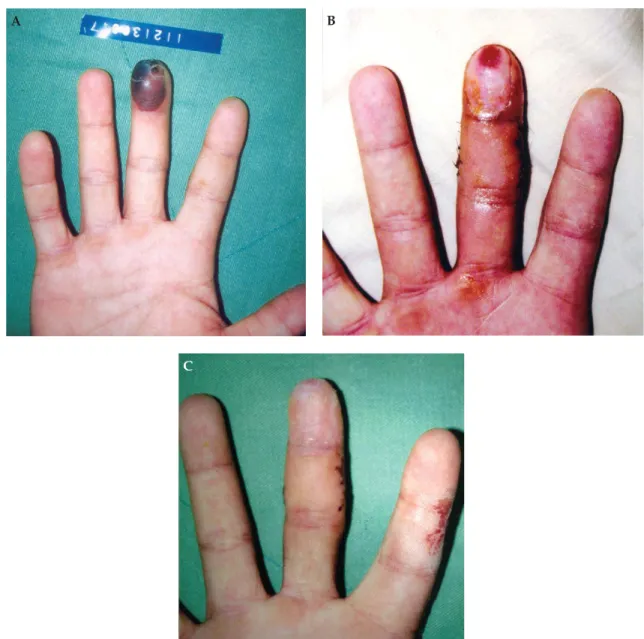 Figure 1. Case 6. (A) Preoperation: cyanosis was noted over the right middle fingertip