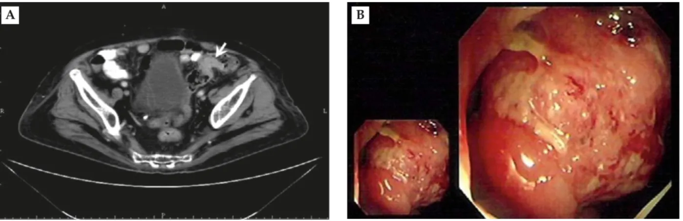 Figure 3. (A) Abdominal computed tomography extended to the pelvic area shows segmental wall thickness over the sigmoid colon (arrow)