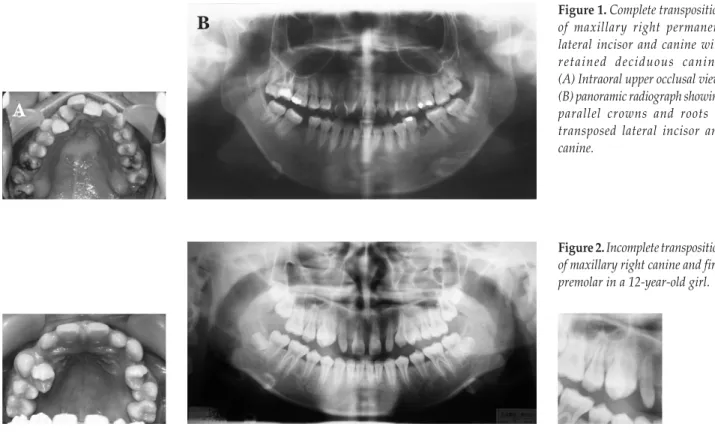Figure 1.  Complete transposition of maxillary right permanent lateral incisor and canine with retained deciduous canine