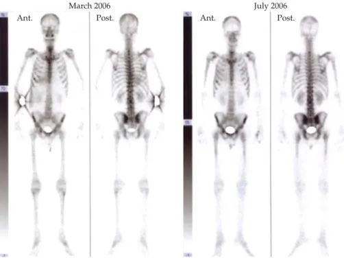 Figure 1. Two MDP skeletal scintigraphies were performed in early March and July. Visualized activity in both soft tissue and kidneys did not support the diagnosis of the super scan