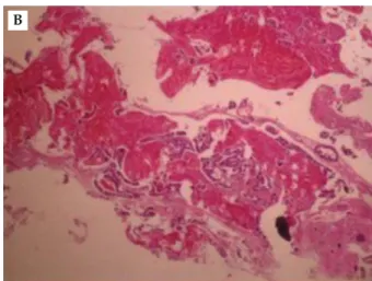 Figure 5. Pathology shows: (A) infiltrative ductal carcinoma of the breast; (B, C) malignant bony metastasis from bony fragment after fixation of pathologic fracture