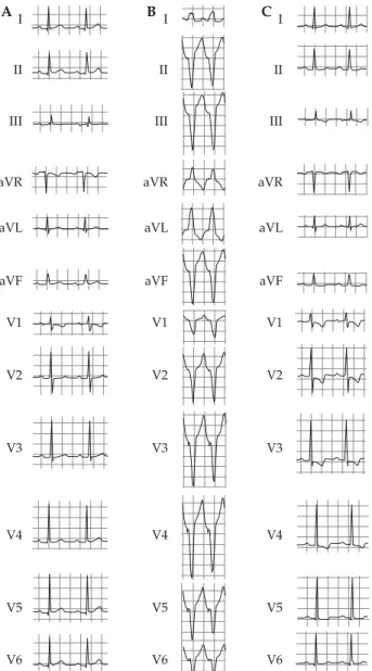 Figure 1. Twelve-lead ECG: (A) at baseline; (B) during pacing from the right ventricular apex (RVA); (C) after RVA pacing