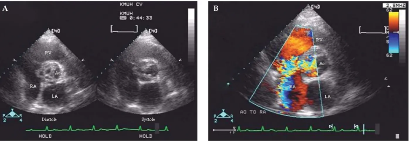 Figure 2. (A) Parasternal short-axis view at the aortic valve plane on 2-D echocardiography