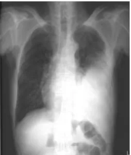 Figure 1.  Chest roentgenography shows a 9 × 15 cm, pleural- pleural-based opacity in the left lower lobe.