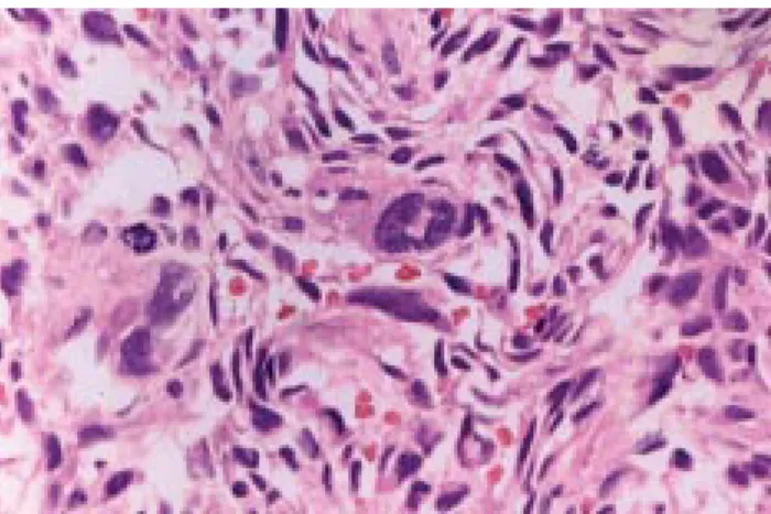 Figure 4.  Histopathology of a thoracoscopic biopsy shows spindle cells and multinucleated giant cancer cells with mitotic figures